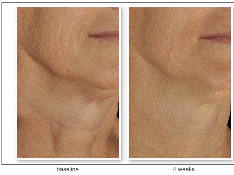 DefenAge before and after results, example 1